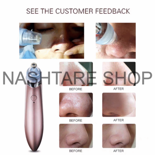 Electric Blackhead Remover | جهاز شفط و إزالة الرؤوس السوداء - Image 2